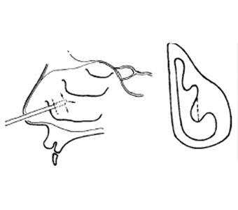Схема подслизистой вазотомии нижних носовых раковин