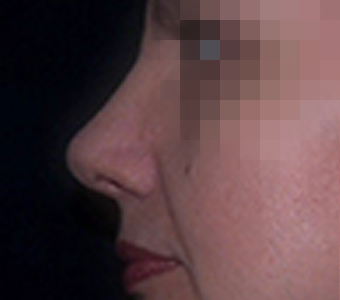 Искривление носовой перегородки (схема)
